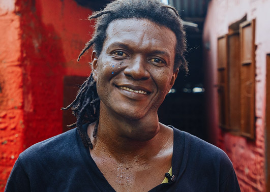 Emmanuel, første patient i Sierra Leone 2023, før operationen.